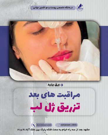 مراقبت های بعد از تزریق ژل لب کلینیک اکسیرجوانی مشهد