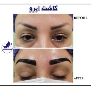 A sample of eyebrow transplant in exirjavani specialized clinic
