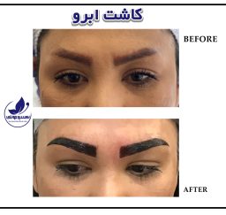 Before and after eyebrow transplant in ExirJavani specialized clinic located in Mashhad