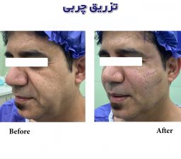 A sample of fat injection for the smile line in ExirJavani specialized clinic