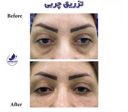 Example of eye filler work (injection of fat into the hollow under the eye) in ExirJavani specialized clinic
