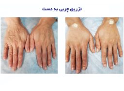 Before and after gel and fat injection in ExirJavani specialized clinic located in Mashhad