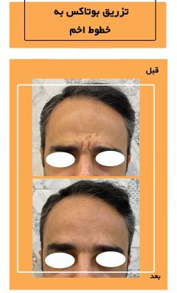 before and after of Botox at exirjavani superspecialty clinic