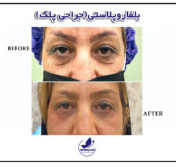 before and after Blepharoplasty Exirjavani beauty clinic in Mashhadlasty