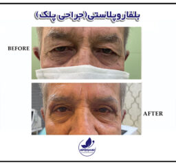 before and after Blepharoplasty Exirjavani beauty clinic in Mashhadlasty