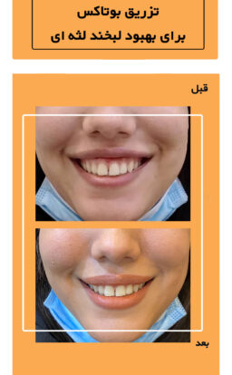 before and after of Botox at exirjavani superspecialty clinic