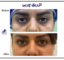 Before and after gel and fat injection in ExirJavani specialized clinic located in Mashhad