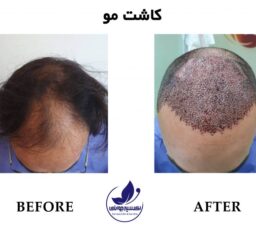 portfolio and before and after hair transplantation in ExirJavani super specialty clinic in Mashhad