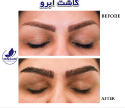 Before and after eyebrow transplant in ExirJavani specialized clinic located in Mashhad