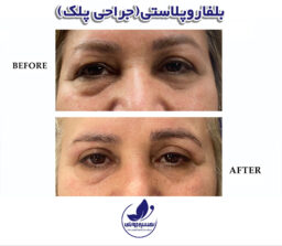 before and after Blepharoplasty Exirjavani beauty clinic in Mashhad
