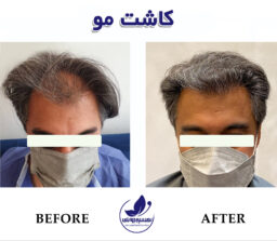 portfolio and before and after hair transplantation in ExirJavani super specialty clinic in Mashhad