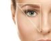 eyebrow transplant in exirJavani specialized clinic
