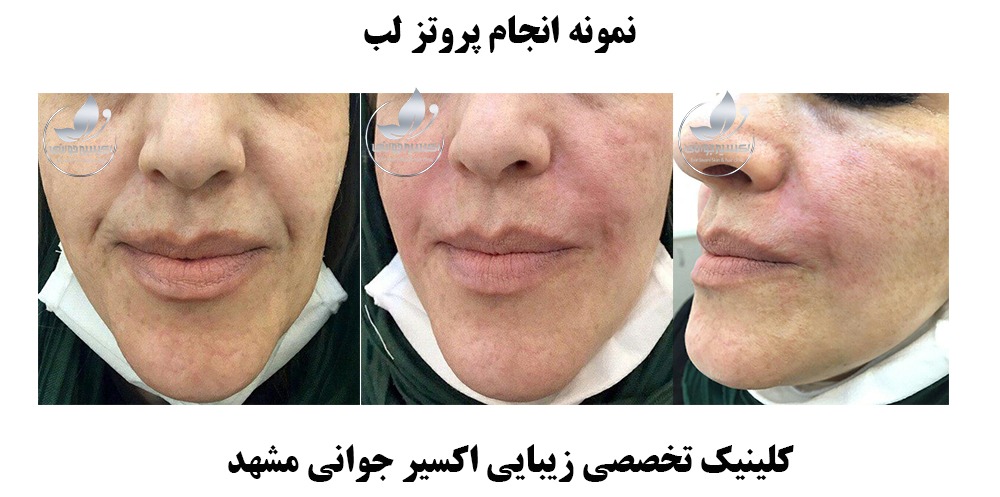 نمونه قبل و بعد پروتز و تزریق ژل لب در کلینیک تخصصی اکسیرجوانی مشهد