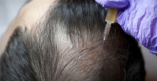 کاشت مو به روش PRP، روش کاشت موی PRP، کاشت مو در کلینیک اکسیر جوانی مشهد