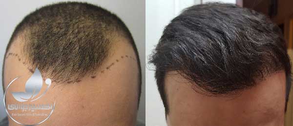 hair transplant SUT, FUT, hair implant
