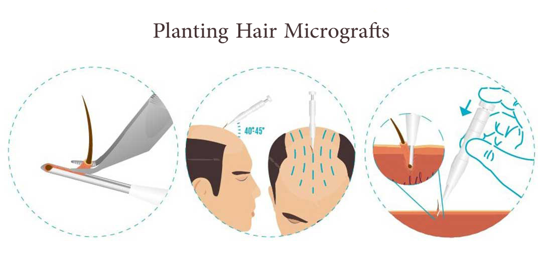 planting hair micrograft