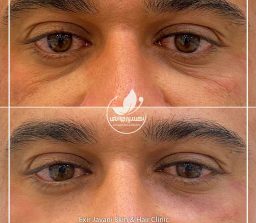 قبل و بعد فیلر چشم با تزریق چربی در کلینیک تخصصی اکسیرجوانی