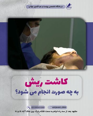 کاشت ریش در کلینیک تخصصی اکسیرجوانی مشهد
