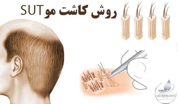 کاشت مو به روش SUT در مشهد